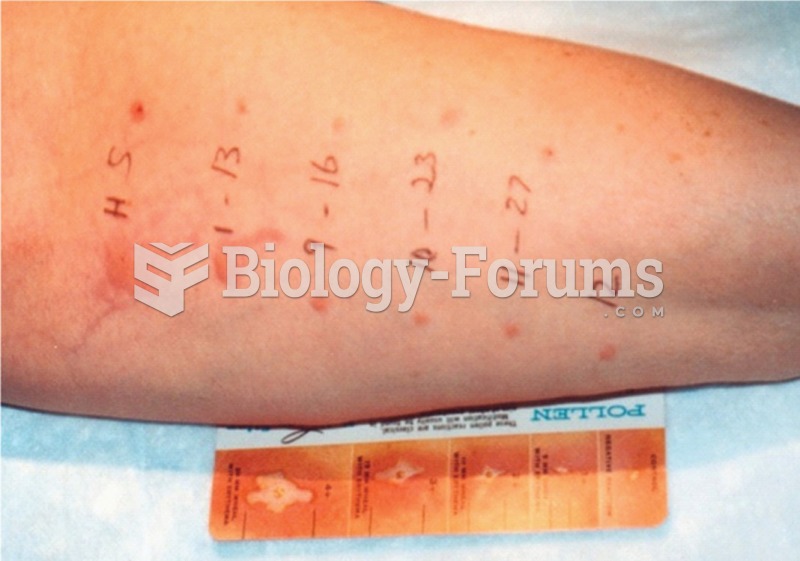 Skin testing. Note the spot labeled H, which is the positive histamine control, and the spot labeled ...