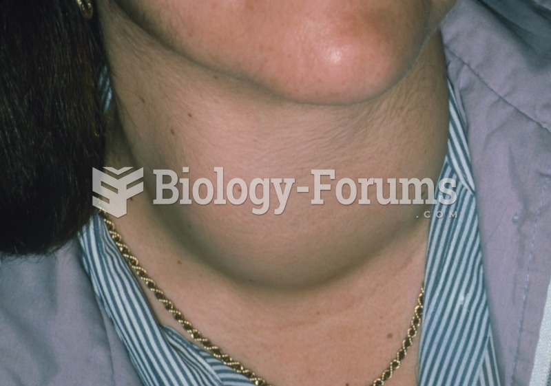 Goiter as commonly seen in autoimmune thyroid disease. 