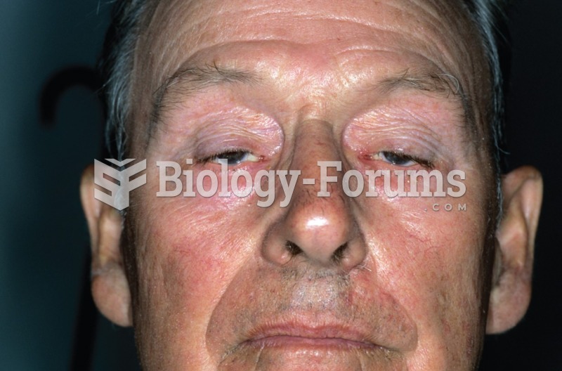 Muscle weakness caused by myasthenia gravis is evident in the eyes of this patient. 