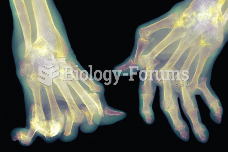 Joint deformities from rheumatoid arthritis. 