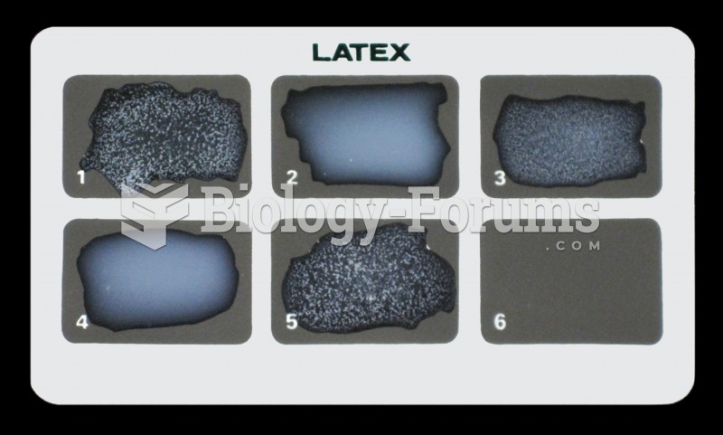 A latex agglutination test for rheumatoid factor. A positive control at 1. A negative control at 2. ...