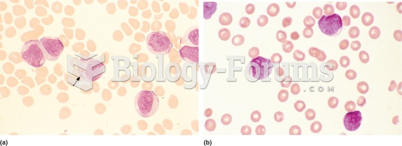 (a) Acute myelocytic leukemia: The tumor cells are of myeloid rather than lymphoid lineage. (b) ...