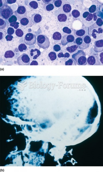 (a) Multiple myeloma: Tumor of plasma cells. (b) Myeloma cells grow within the bone and lesions can ...