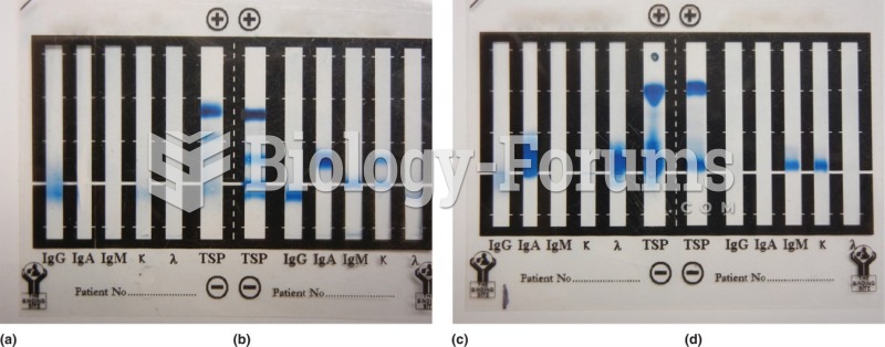 Immunofixation electrophoresis. (a) IgG kappa myeloma, (b) Controls showing total serum protein ...