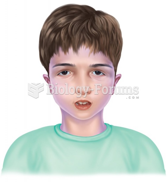 Patient with DiGeorge syndrome. Note low set ears and wide set downward slanting eyes; often these ...