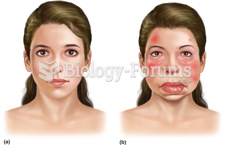 Typical clinical manifestation of hereditary angioedema (C1 inhibitor deficiency). You can see a ...