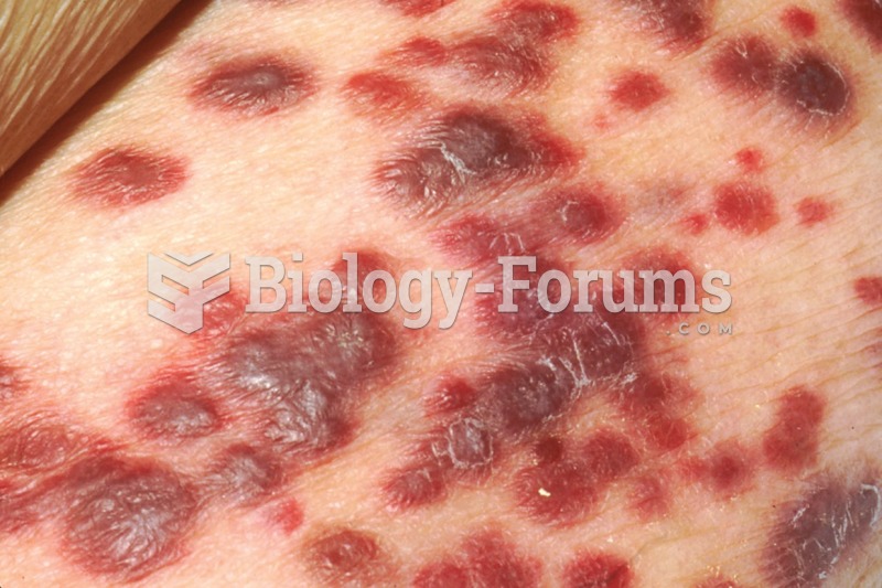 Kaposi's sarcoma on the skin of an AIDS patient. 