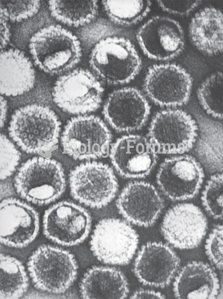 A Herpesviridae virus, the herpes simplex virion. It has an icosahedral capsid with double-stranded ...