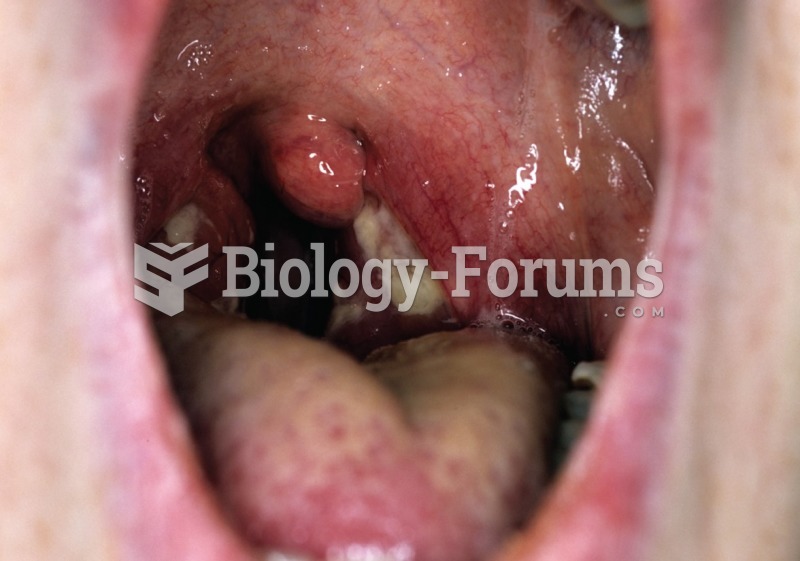 Diffuse pharyngeal erythema seen with infectious mononucleosis. 