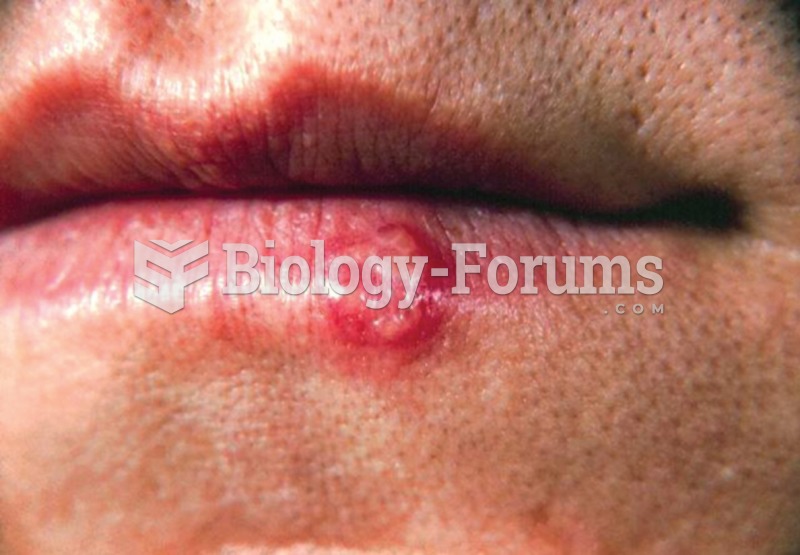 Herpes simplex virus sore on the lip
