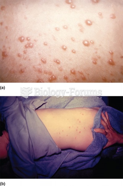 (a) Chicken pox vesicles. (b) Chicken pox on back of young patient. 