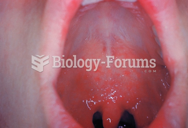 Koplik spots in the mouth of a patient with measles. 