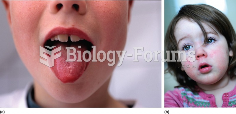 "Strawberry tongue" and circumoral pallor in scarlet fever. 