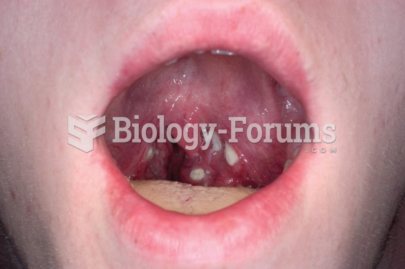 Inflammation of the oropharynx and petechiae (small red spots) on the soft palate caused by strep ...