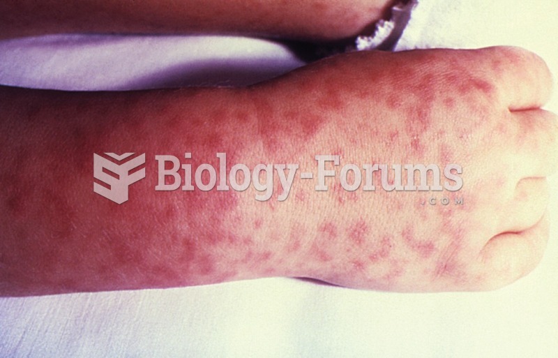 Child's right hand and wrist displaying the characteristic spotted rash of Rocky Mountain ...