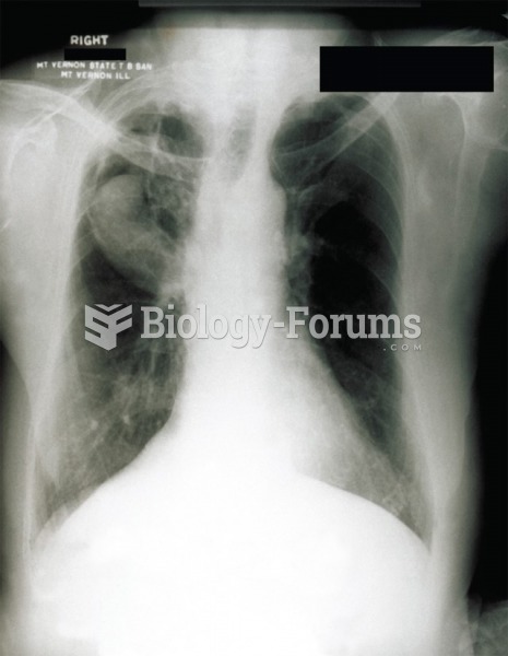 Aspergillosis fungal ball in the right lung.