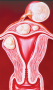 Benign tumor: Fibroid tumors of the uterus. 