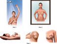 Steps of screening test: breast self-exam. Early detection can find cancer when it is most curable. ...