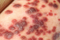 Kaposi&#039;s sarcoma on the skin of an AIDS patient. 