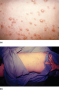 (a) Chicken pox vesicles. (b) Chicken pox on back of young patient. 