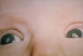 Cataracts seen in a child with congenital rubella syndrome. 