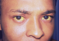Jaundice seen in the eyes and the skin of a patient with hepatitis A.