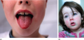 &quot;Strawberry tongue&quot; and circumoral pallor in scarlet fever. 