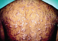 Dermatologic manifestations of secondary syphilis on an old man with AIDS. On dark field ...