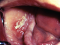 Oral Candida in mouth of HIV patient.