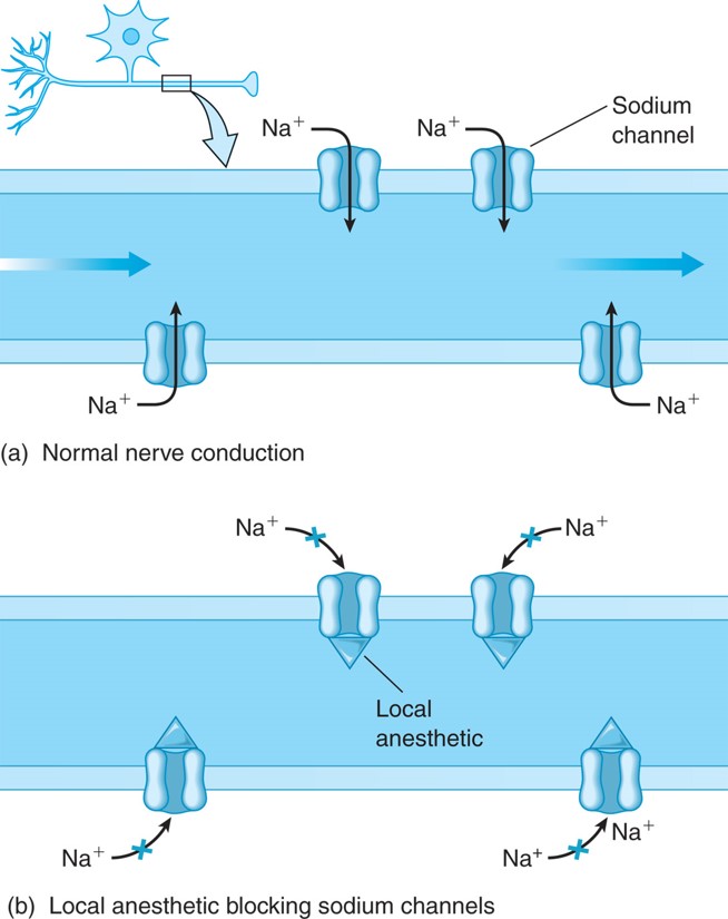 How a local anesthetic blocks nerve conduction.