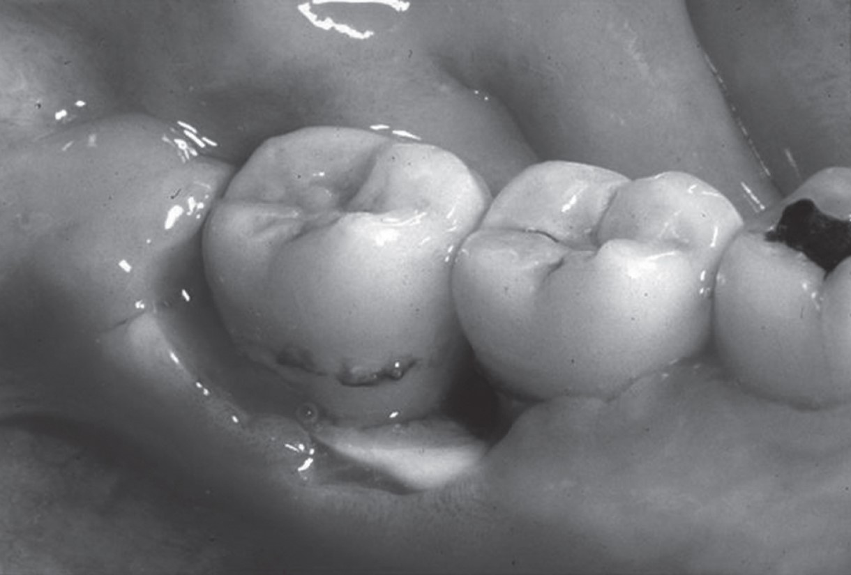 Case of ONJ that occurred spontaneously. Note the white area, which is exposed necrotic bone. 