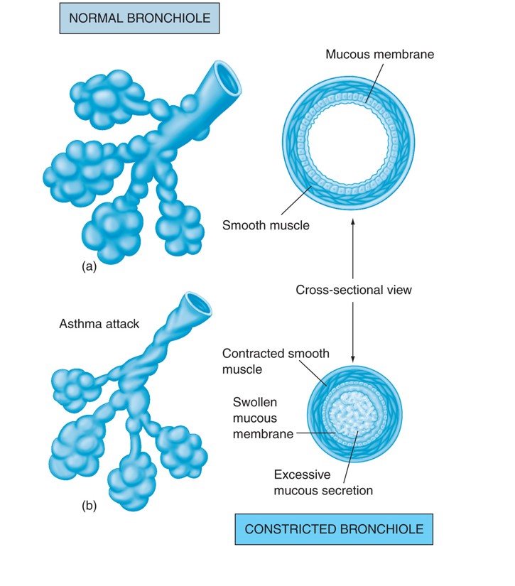 Changes in bronchioles during an asthma attack: (a) normal bronchiole; (b) asthmatic bronchiole.