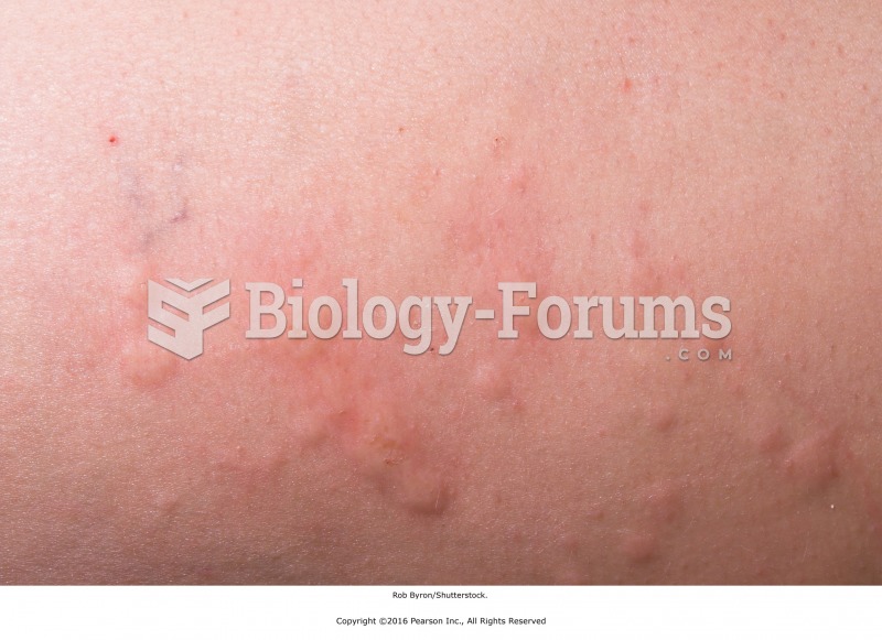 Hives is a general contraindication in the acute phase and a local contraindication in the subacute ...