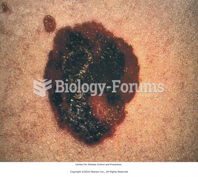 Melanoma is a local contraindication for massage.