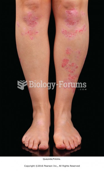 Psoriasis is a local contraindication for massage only during an acute outbreak.