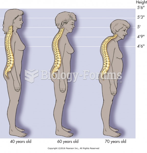 Spinal changes caused by osteoporosis. Use light pressure and gentle stretches only with frail or ...