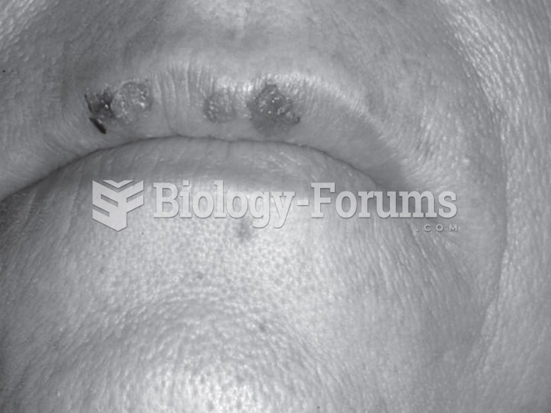 Herpes labialis on the vermillion border of the lip. (Courtesy of U.S. Pharmacist).