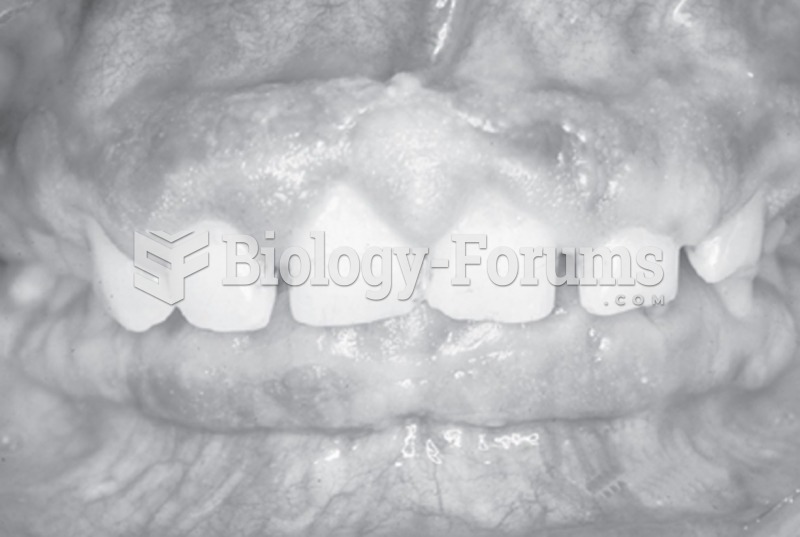 Gingival enlargement in a patient taking phenytoin.