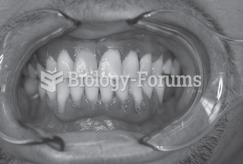Severe periodontitis in a patient with uncontrolled diabetes. 