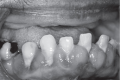 Gingival enlargement in a patient taking nifedipine.
