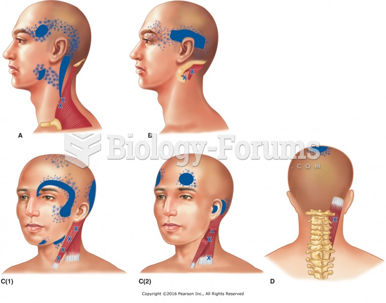 Locations and reference zones of trigger points that cause headaches. A. Upper trapezius. B. ...