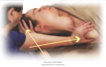 Stretch the cervical muscles with neck in lateral flexion. Place one hand on the shoulder and the ...