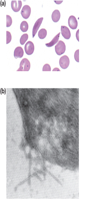 Erythrocytes in sickle-cell disease