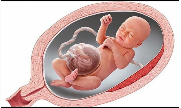 Omphalocele (intramural wall)