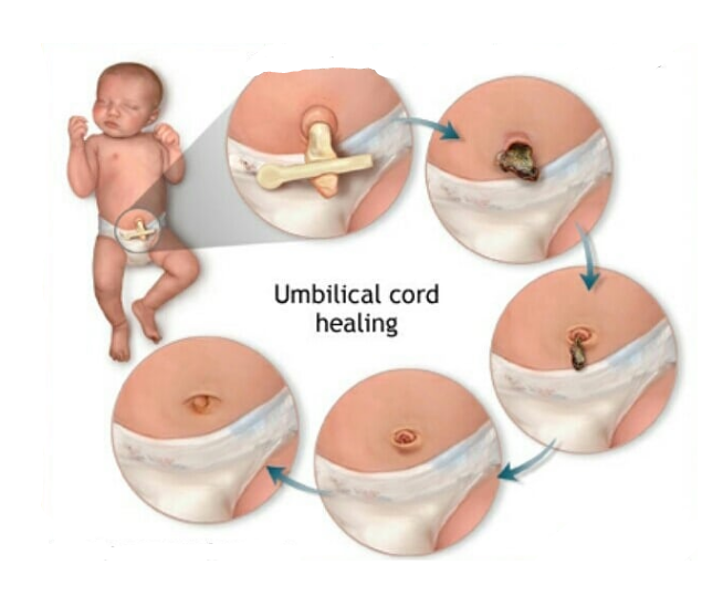 Umbilical cord healing