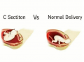How did you give birth? C section vs. Normal Delivery