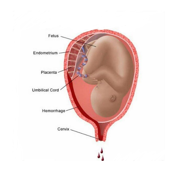 Early Pregnancy Visible Bleeding النزيف في بداية الحمل