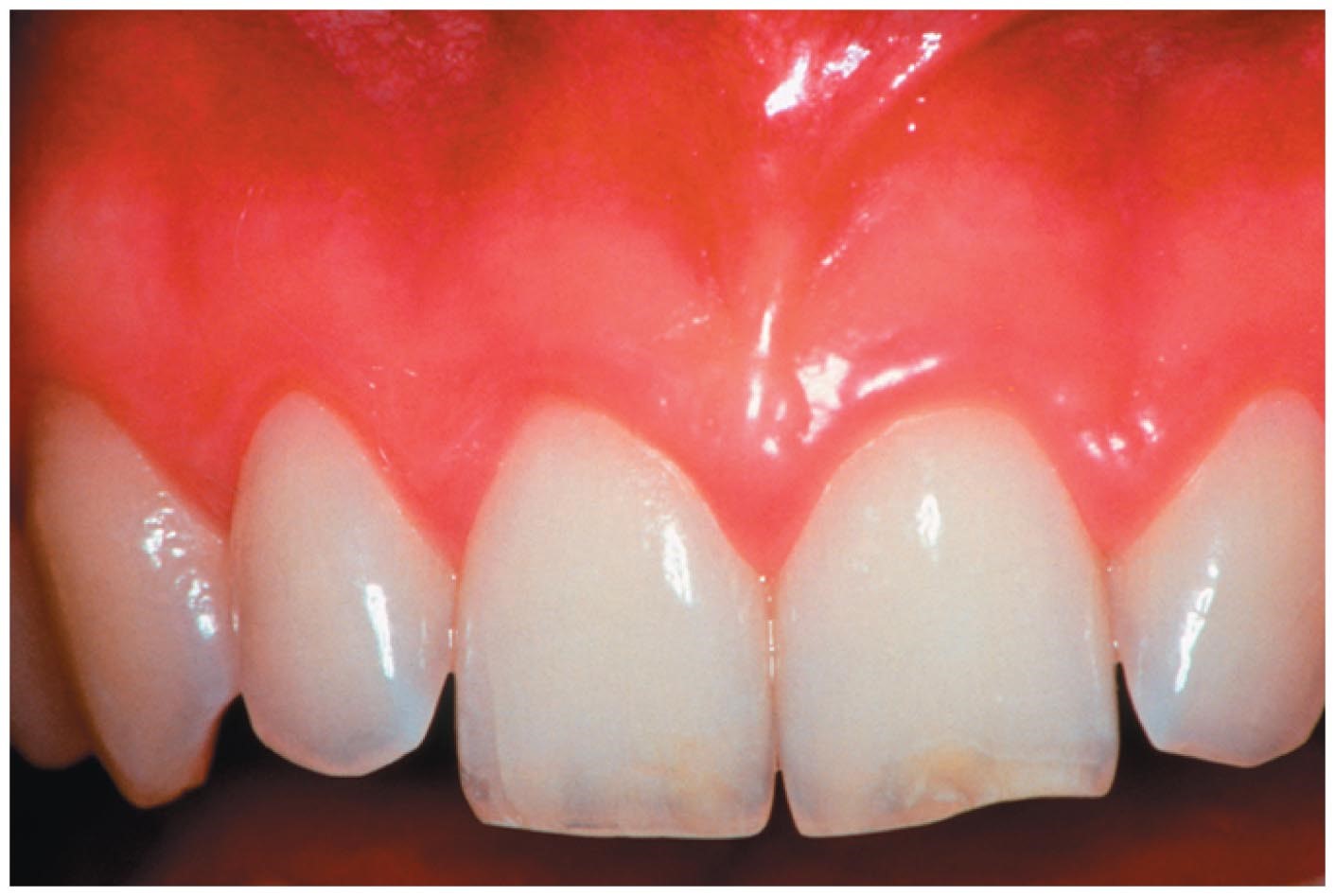 Gingivitis causes redness and swelling of the gums and can lead to more serious gum disease