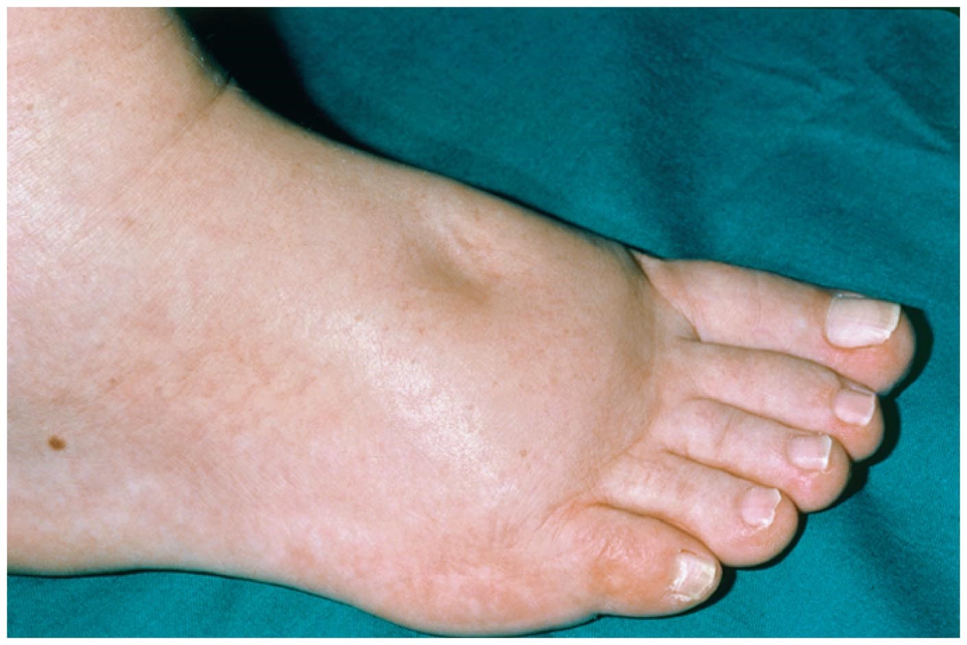 Edema