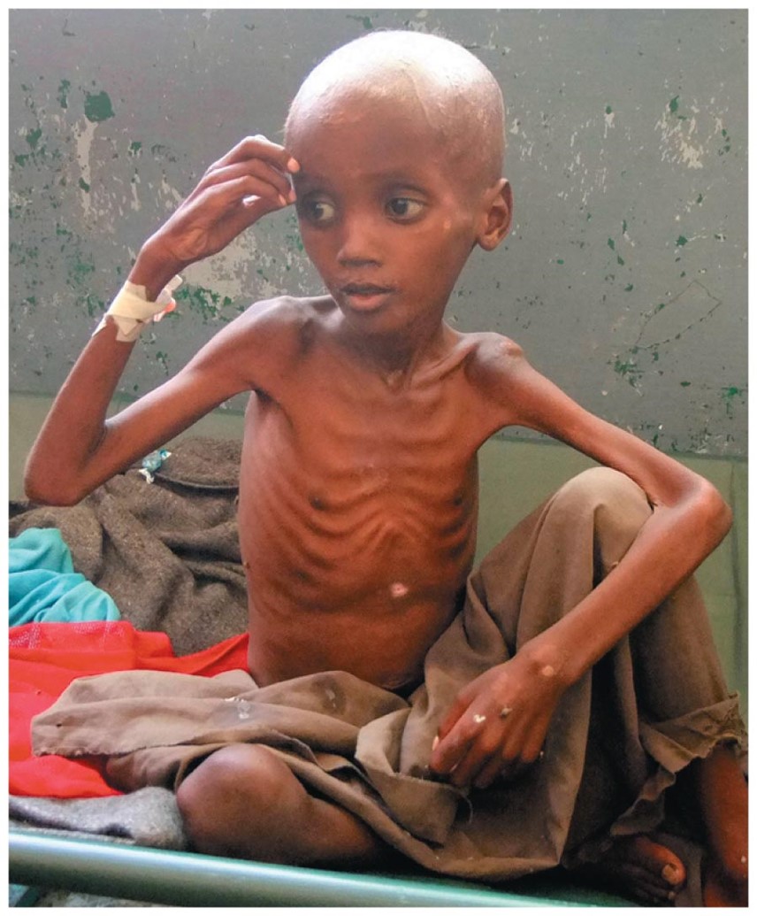 Marasmus The emaciated appearance of this child is a sign (and symptom) of marasmus